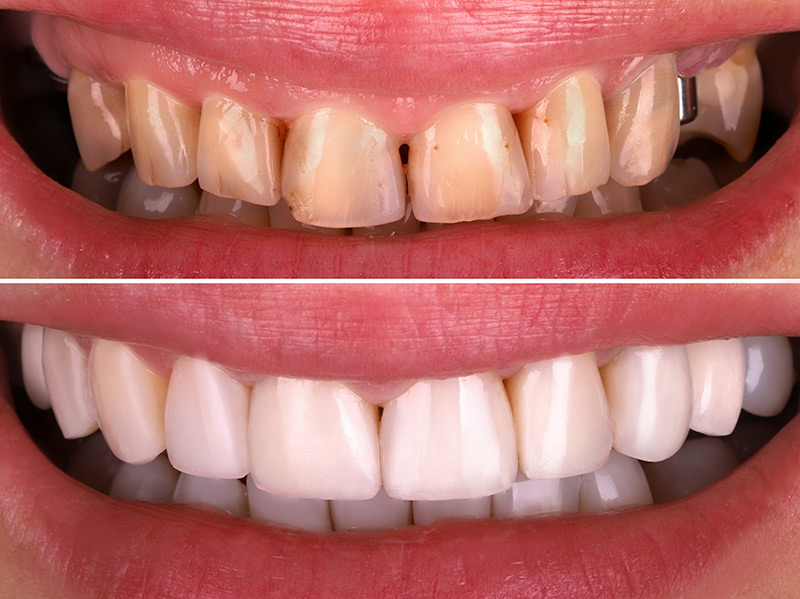 Common Restorative Dental Procedures Explained