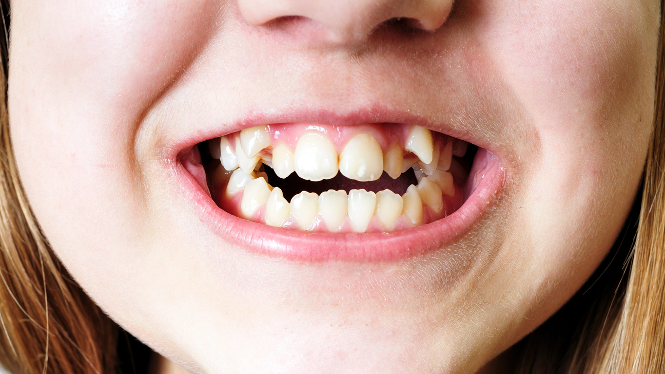 Fix your teeth